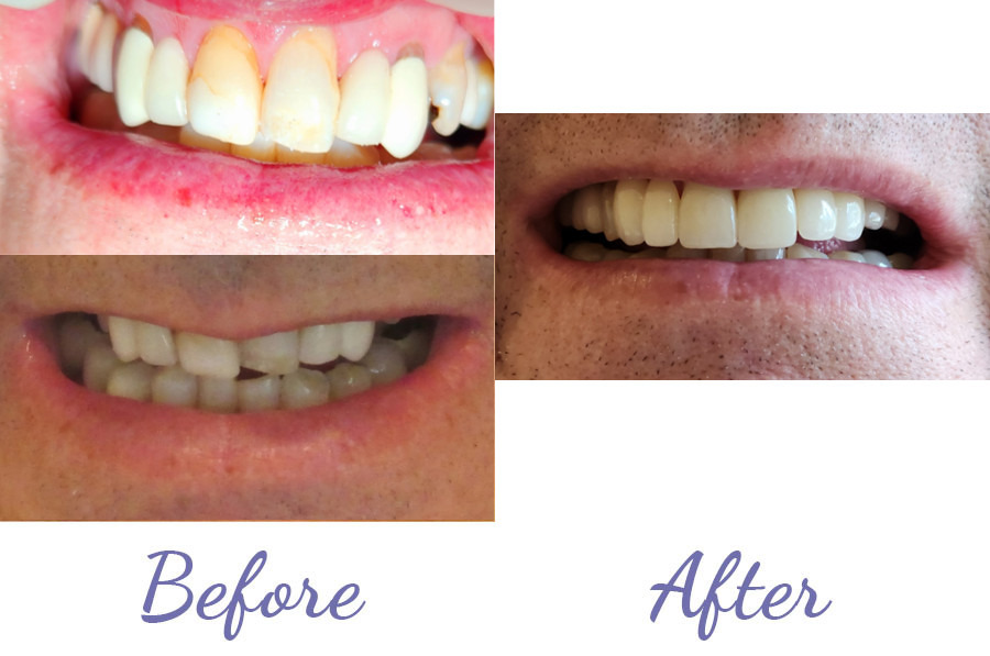 Clear Aligners